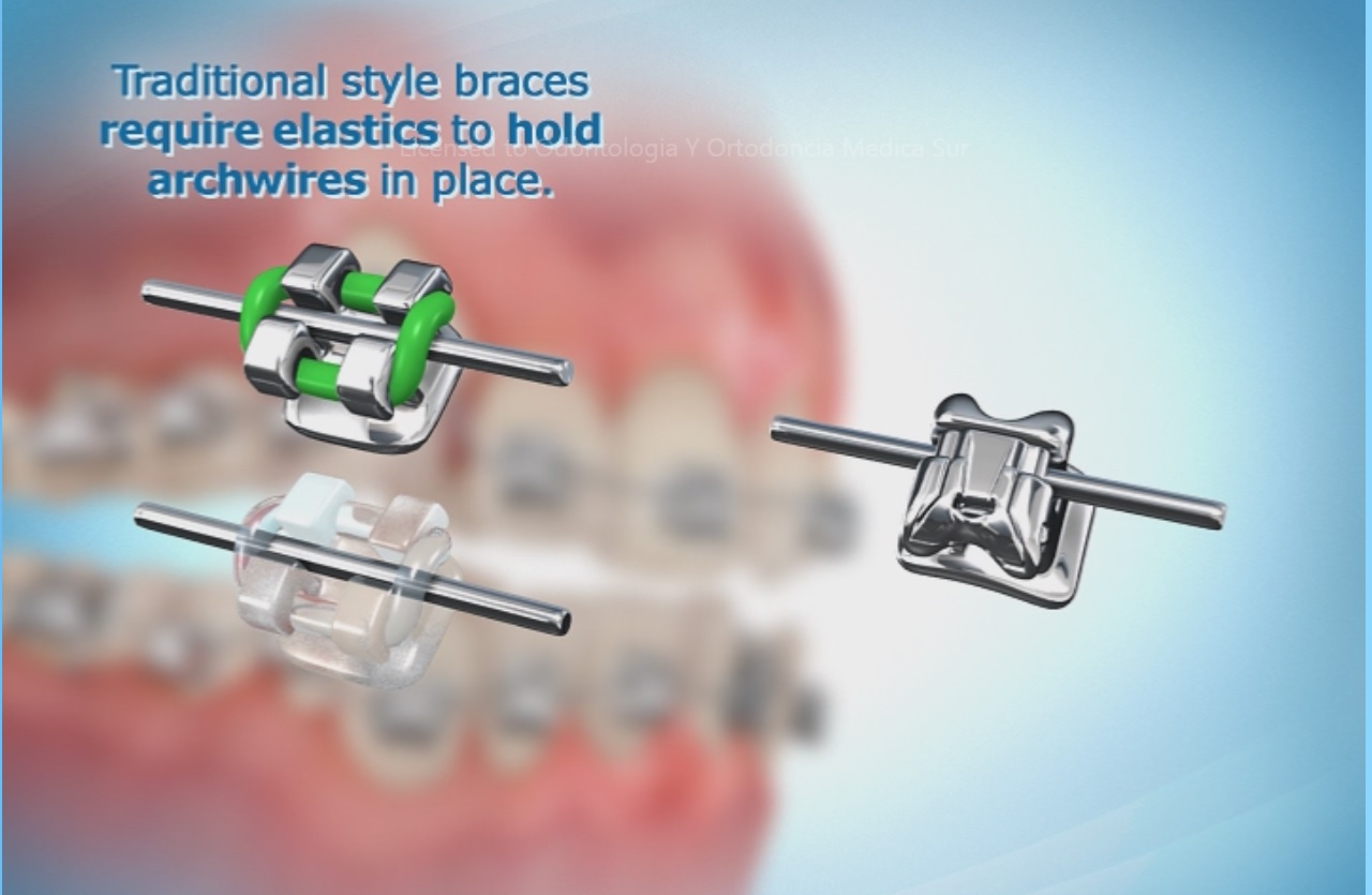 los brackets de autoligado Dentista Medica Sur